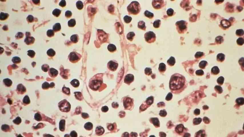 Schweiz meldet einen Hantavirus-Fall