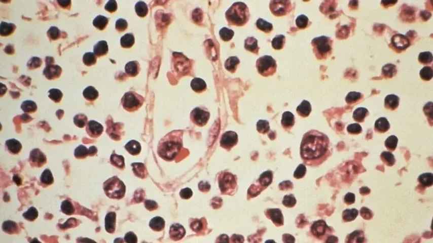 Schweiz meldet einen Hantavirus-Fall