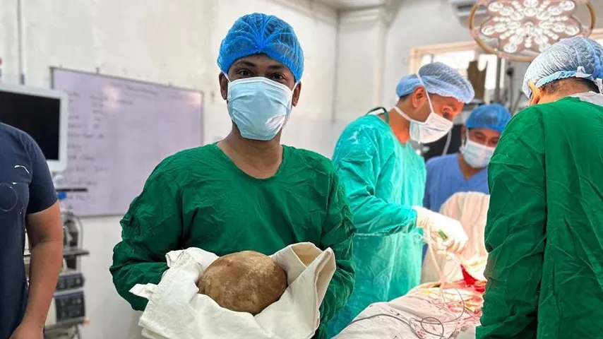 3,1 kg Nierenstein: Ärzte behaupten Rekord, „so groß wie ein Straußenei